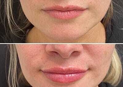 Lip Filler Before & After