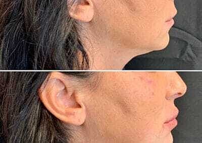 Lip Filler Before & After