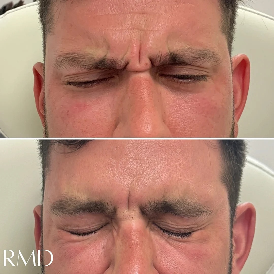 Botox Before & After