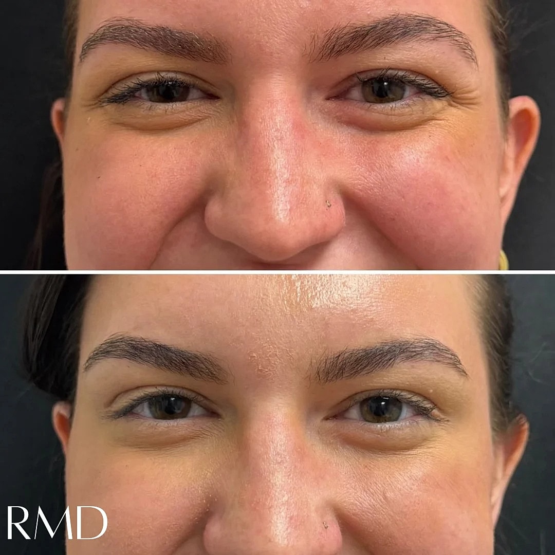 Botox Before & After