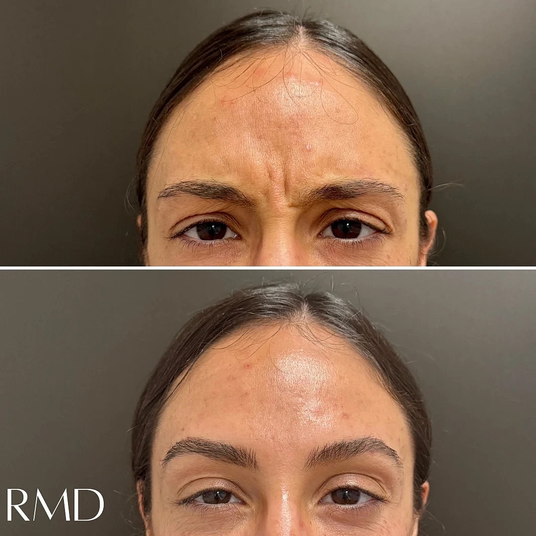 Botox Before & After