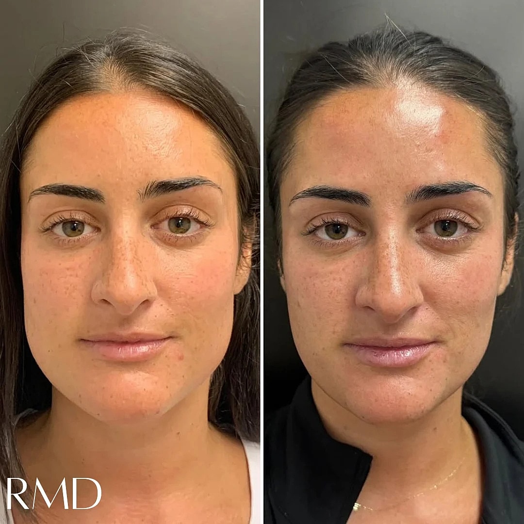 Botox Before & After