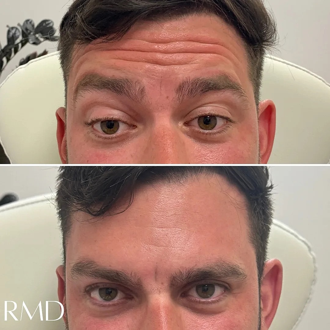 Botox Before & After