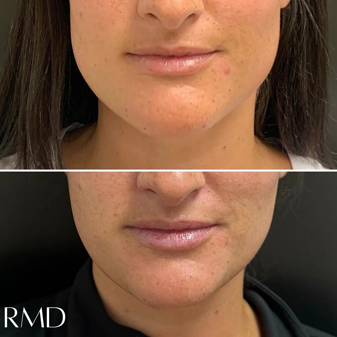 Botox Before & After
