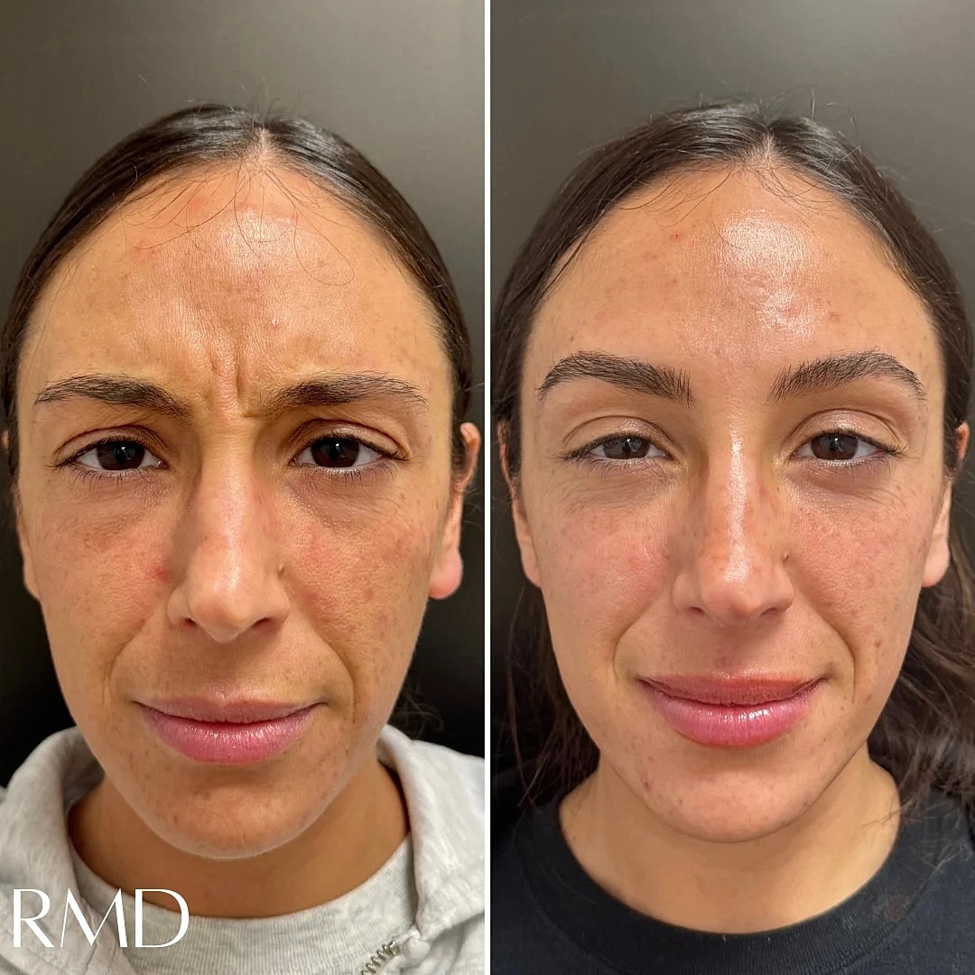 Botox Before & After