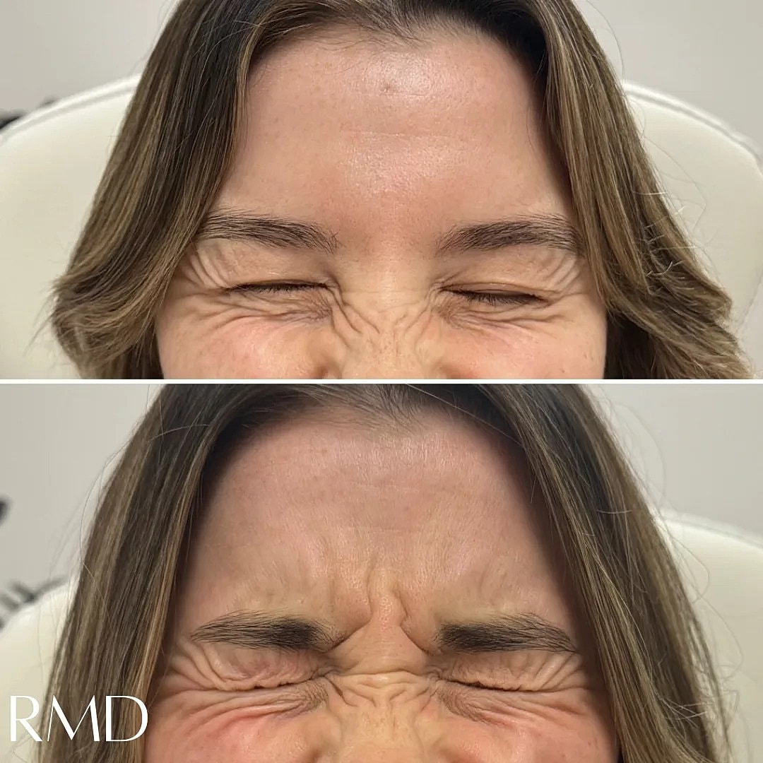 Botox Before & After