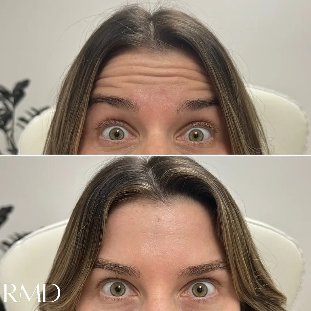 Botox Before & After