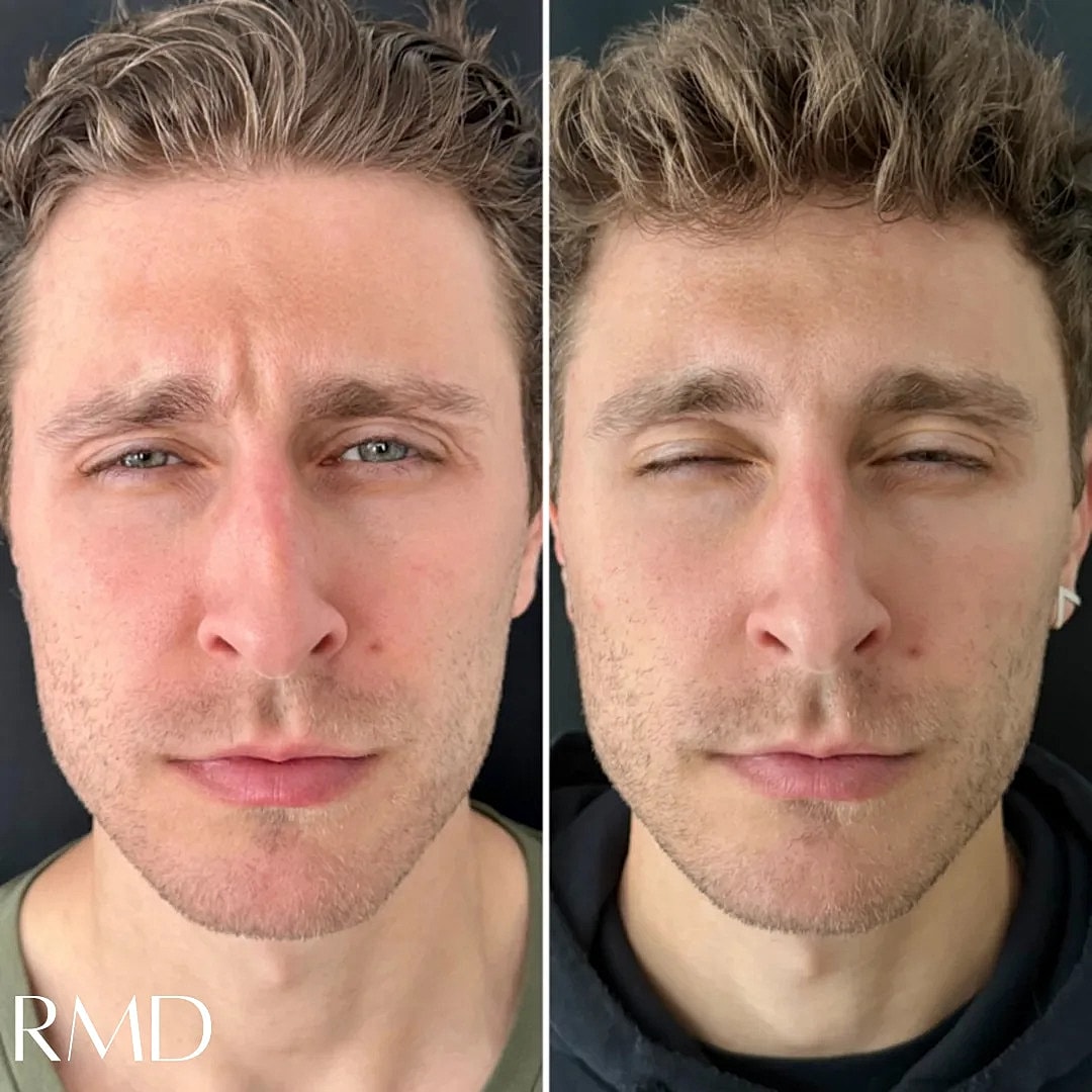 Botox Before & After