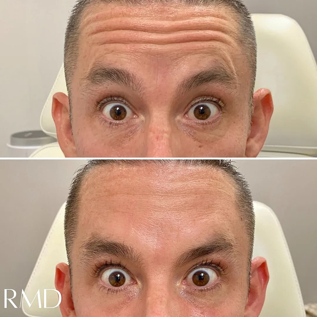Botox Before & After