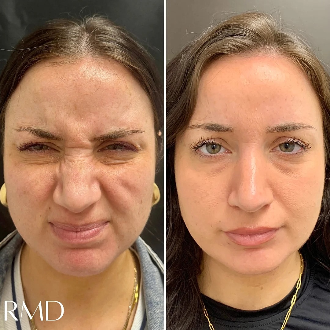 Botox Before & After