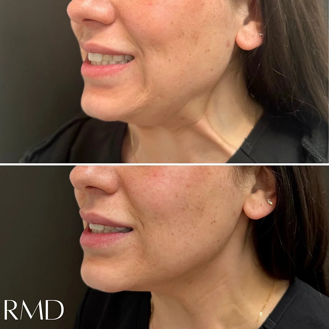 Botox Before & After