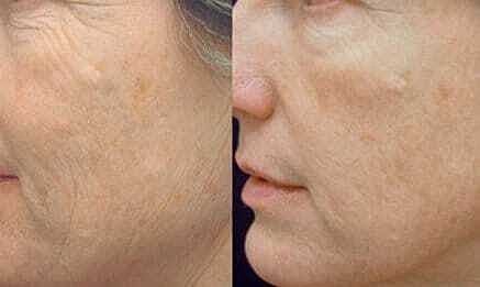 Skin Tightening Before & After