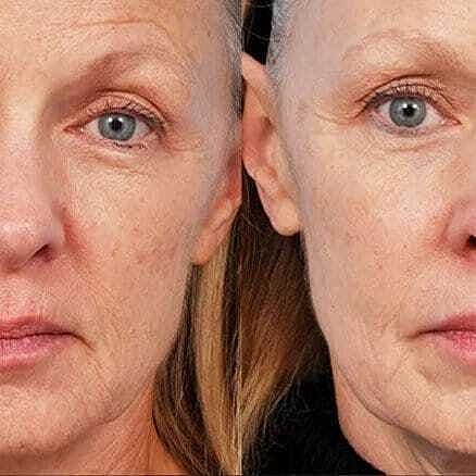 Skin Tightening Before & After