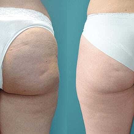 Skin Tightening Before & After
