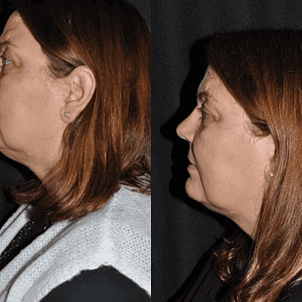 Kybella Before & After