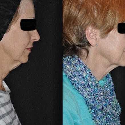 Kybella Before & After