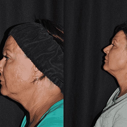 Kybella Before & After