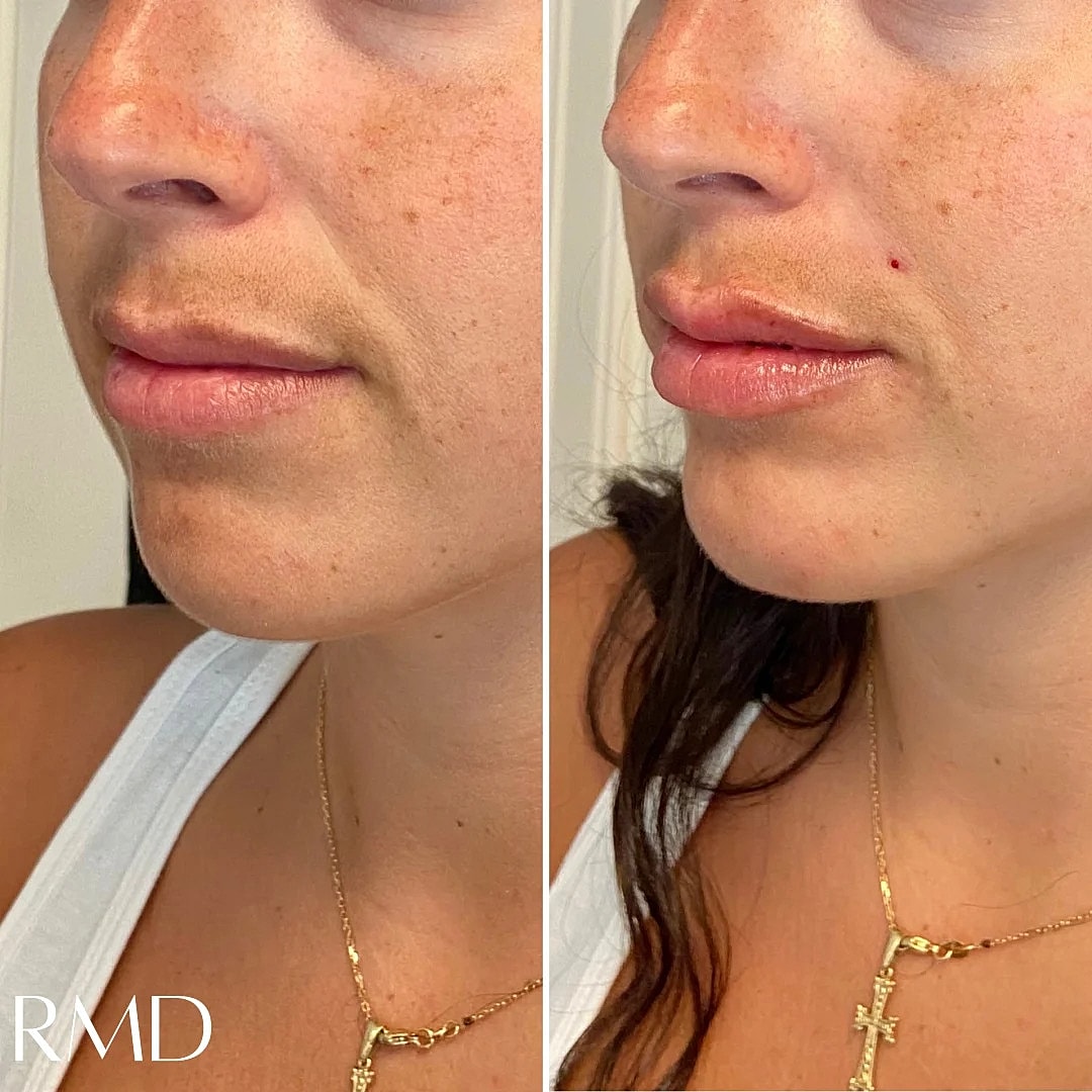 Lip Chin Filler Before & After