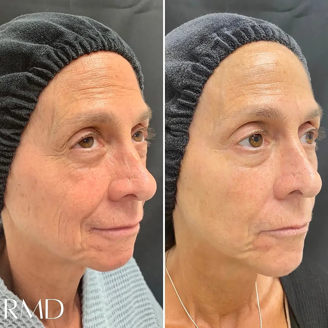Lip Chin Filler Before & After