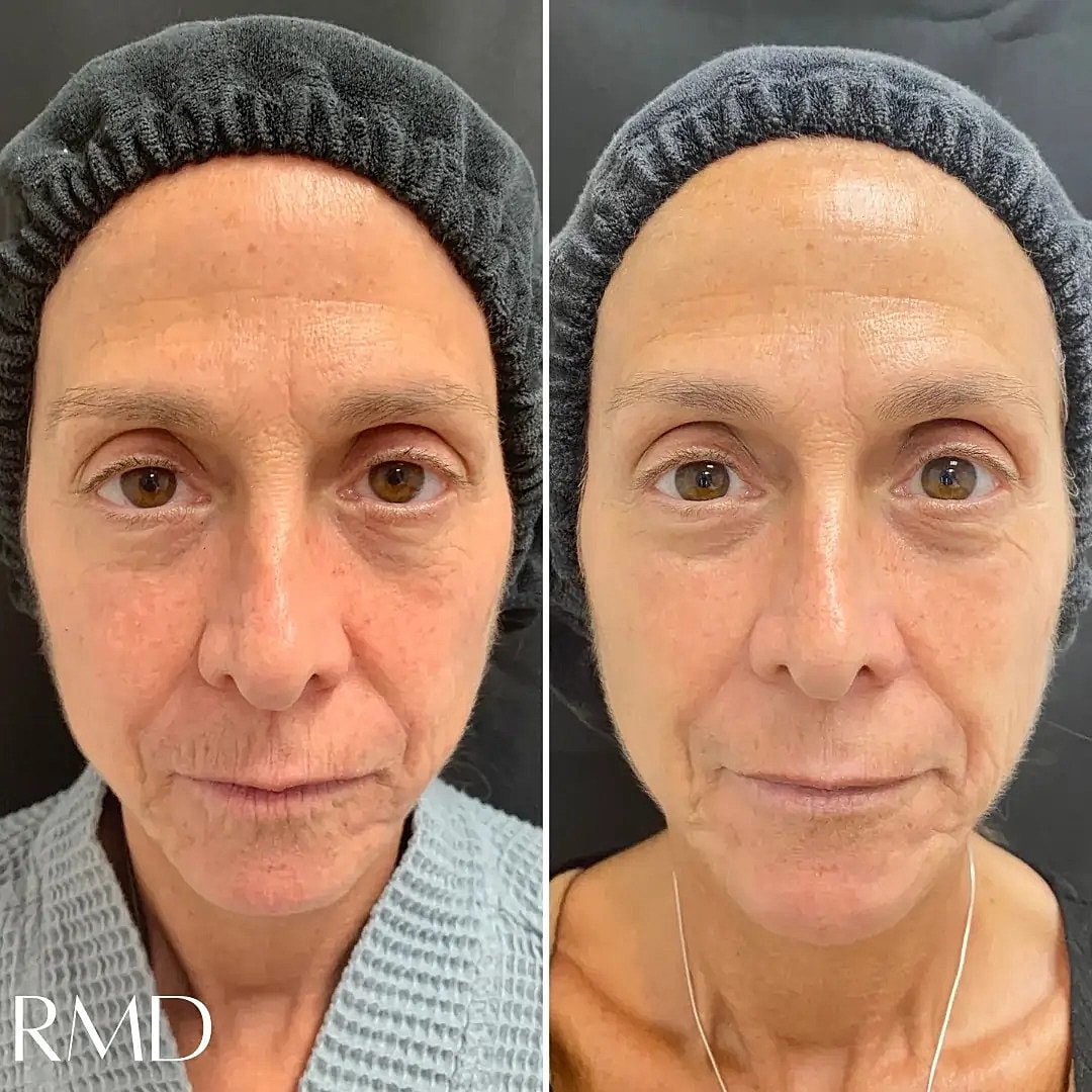 Lip Chin Filler Before & After