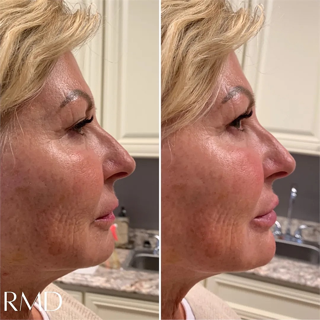 Lip Chin Filler Before & After
