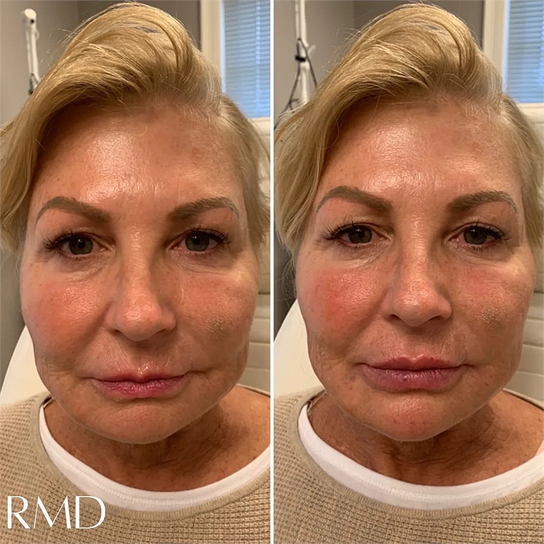 Lip Chin Filler Before & After