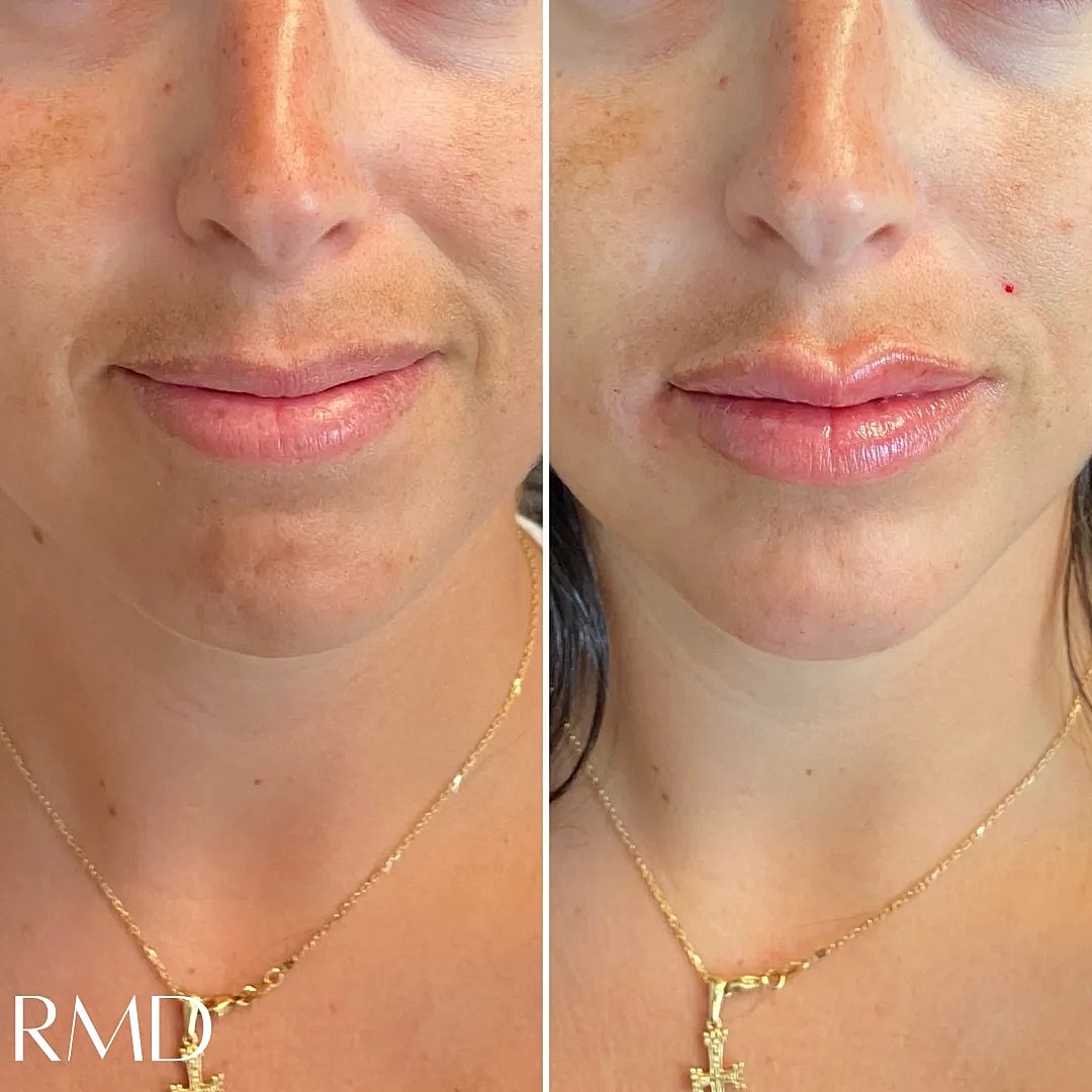 Lip Chin Filler Before & After