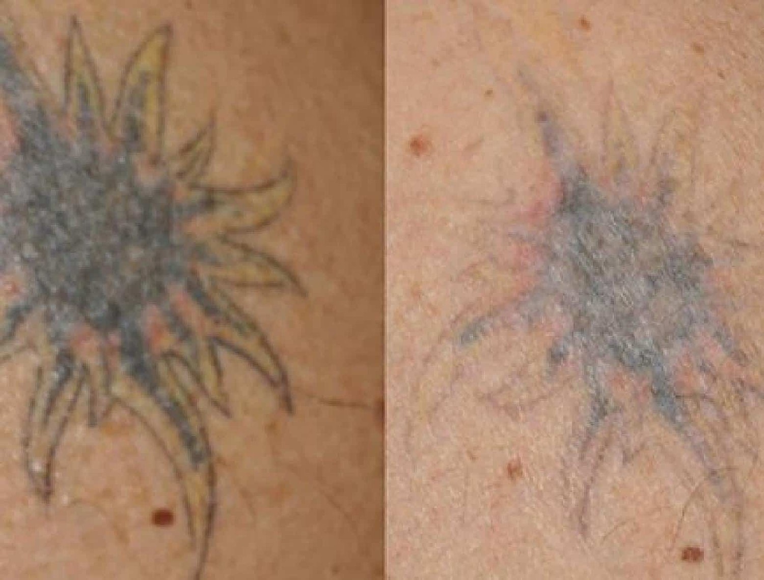 Tattoo Removal Before & After