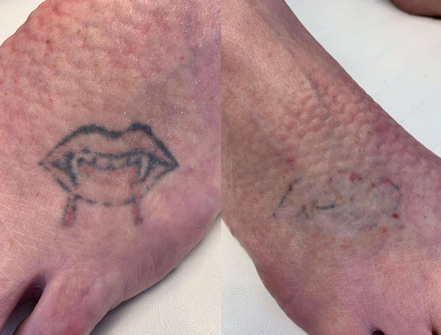 Tattoo Removal Before & After