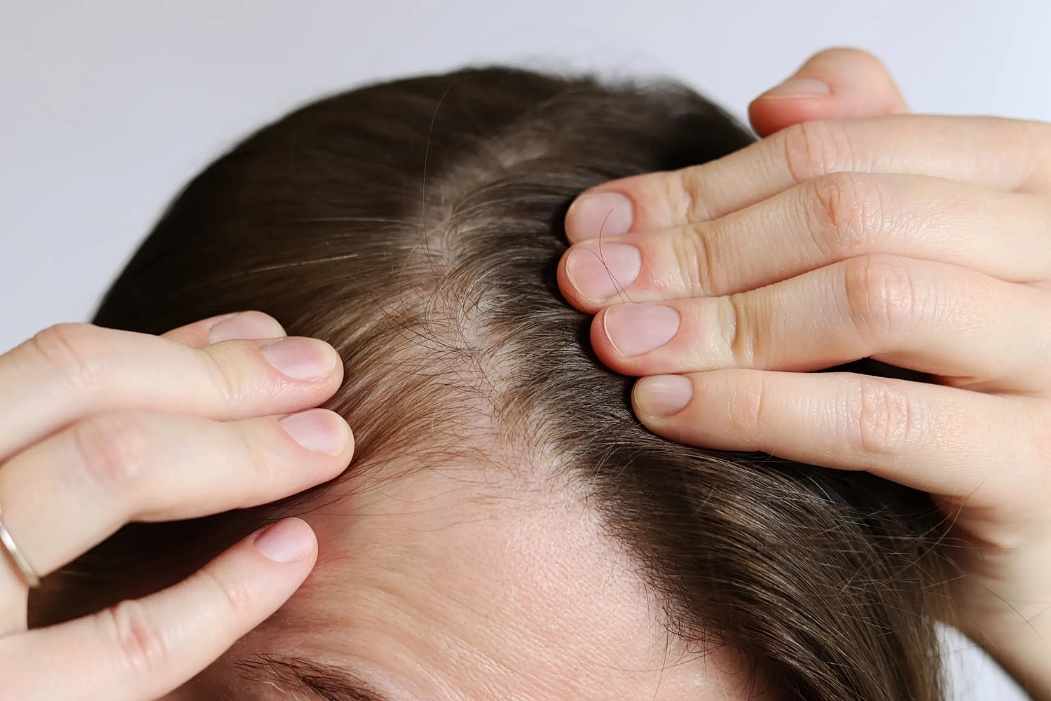 Hair Loss & Hair Restoration Treatment in Northborough, MA