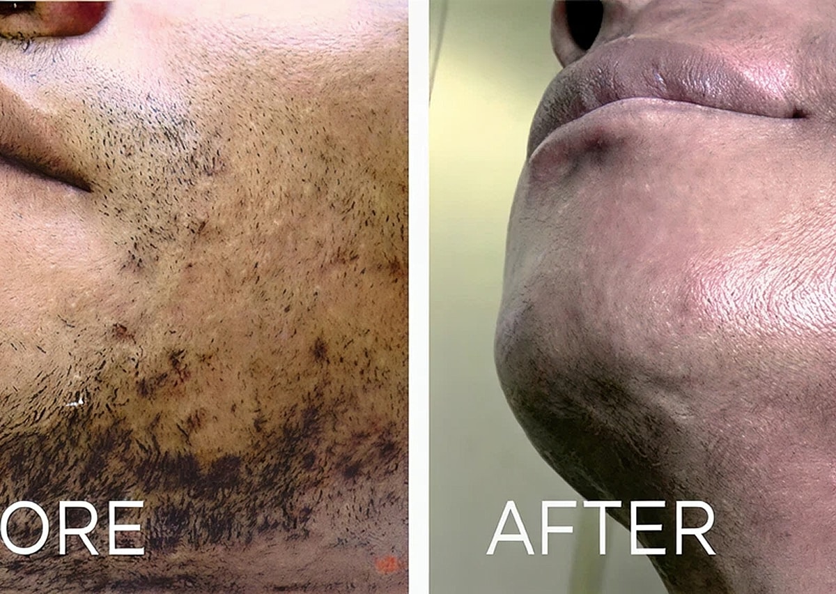 Electrolysis Before And After in Northborough, MA | ONORÉ