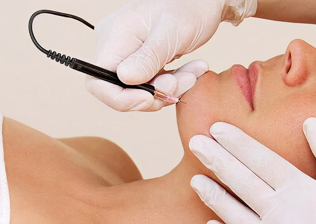 Electrolysis Laser Hair Removal in Northborough MA | Best Medical Spa in Northborough, MA