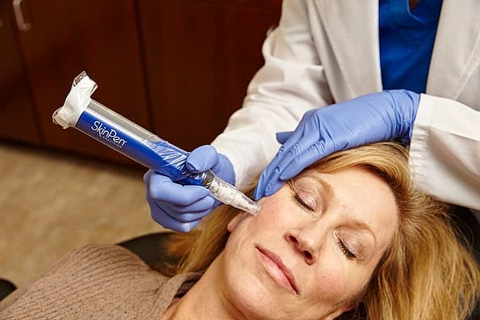 microneedling in Northborough, MA