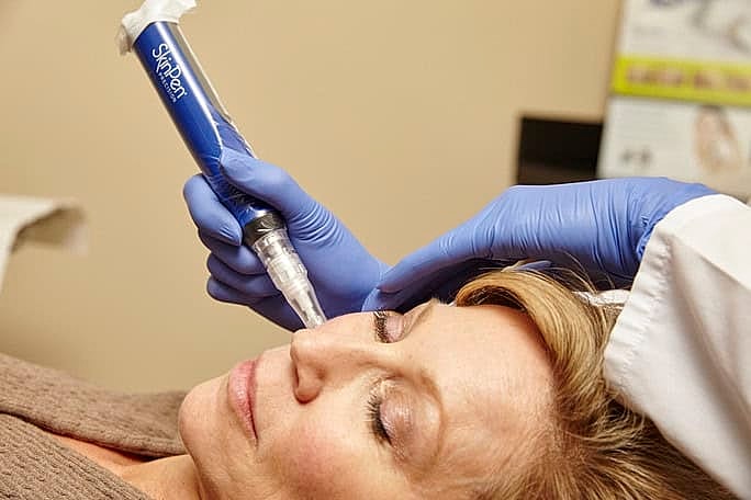 Microneedling with Skinpan in Northborough, MA | ONORÉ